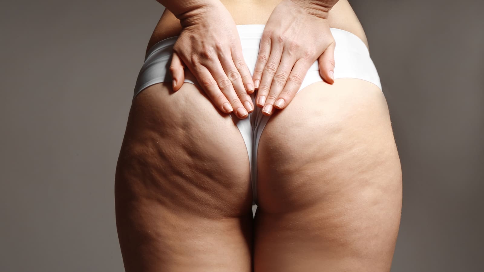Cellulite on buttocks