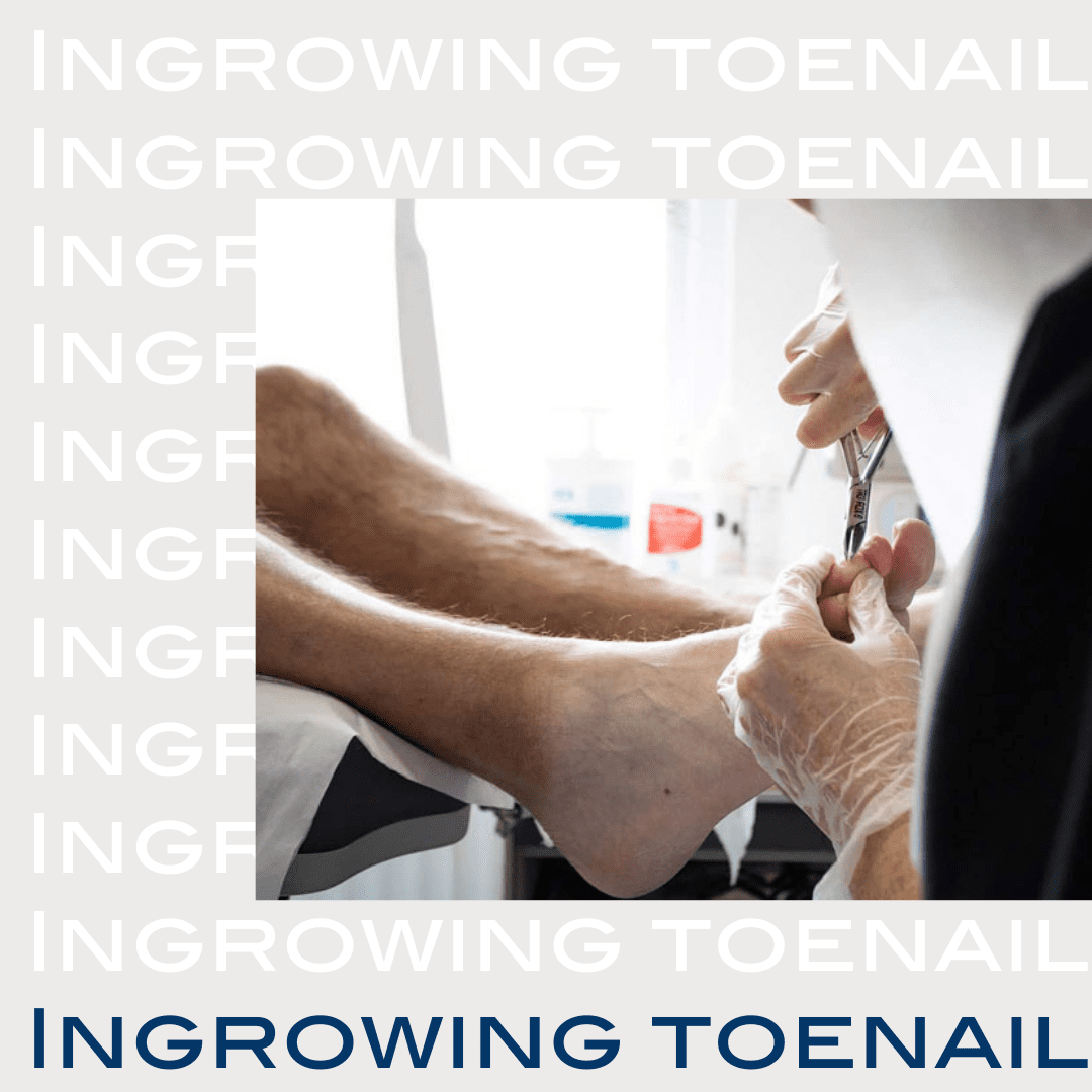 Now is the time for ingrowing toenail surgery