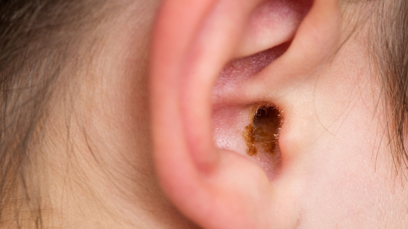 What happens if I have too much ear wax?