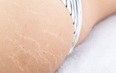 What causes stretch marks?